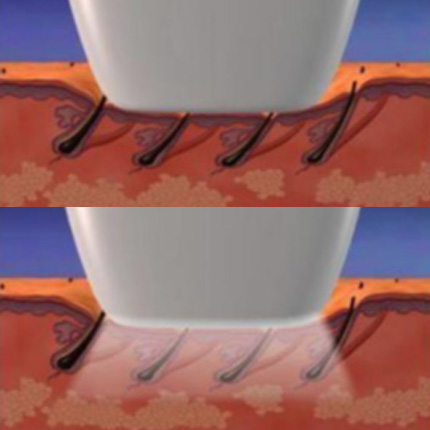 IPL vs LASER depilação